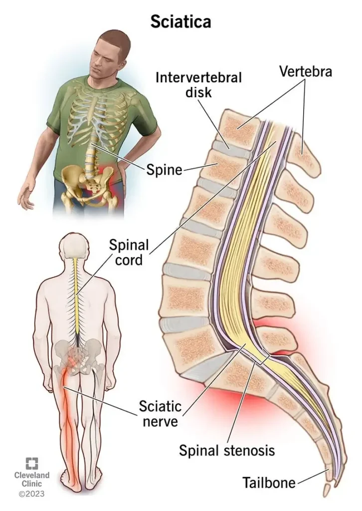 What is a Sciatica