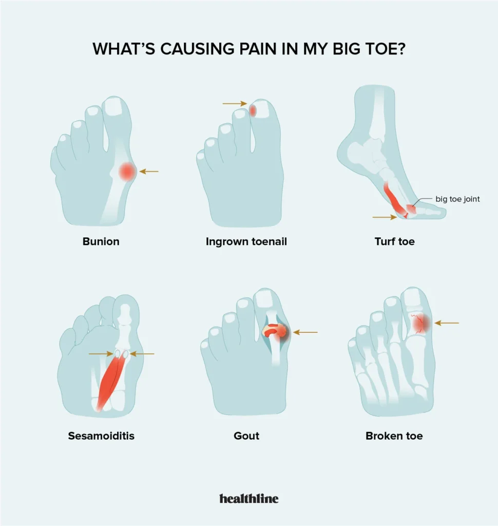 Reasons why the big toe hurts after running