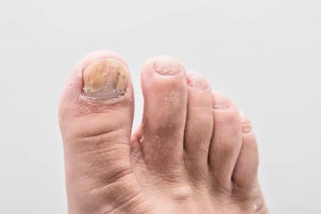Runner losing toenails from running