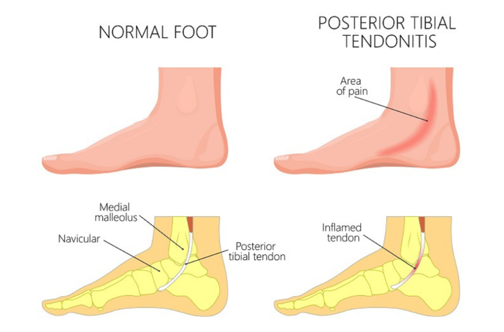 Posterior Tibial Tendonitis injuries